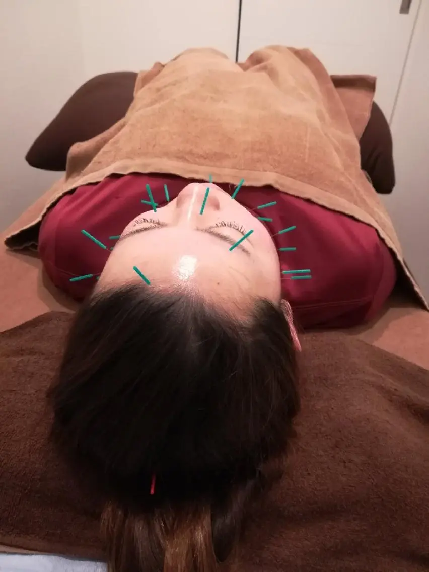 美容鍼灸の写真