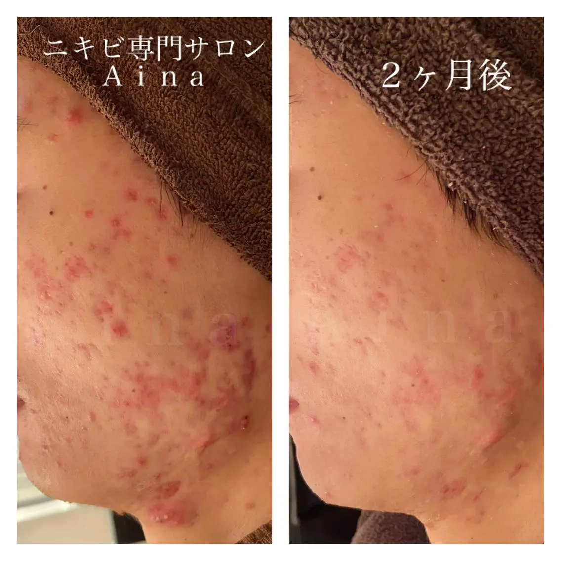 ロング カラー パーマ ヘアアレンジ メンズ キッズ ネイル マツエク・マツパ ブルーカラー ブルー 赤色 エステ リラク ニキビ跡専門サロン Ａｉｎａのエステ・リラクイメージ