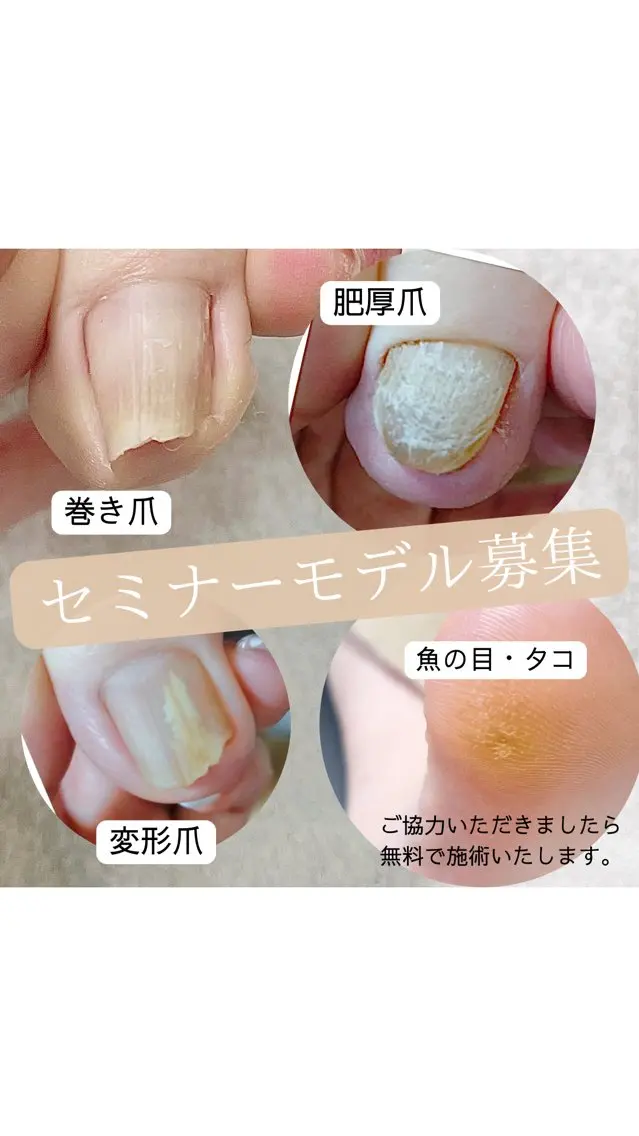 【通常24,200円→無料】巻き爪・肥厚爪・変形爪・魚の目・タコ・角質セミナーモデル募集📣の写真