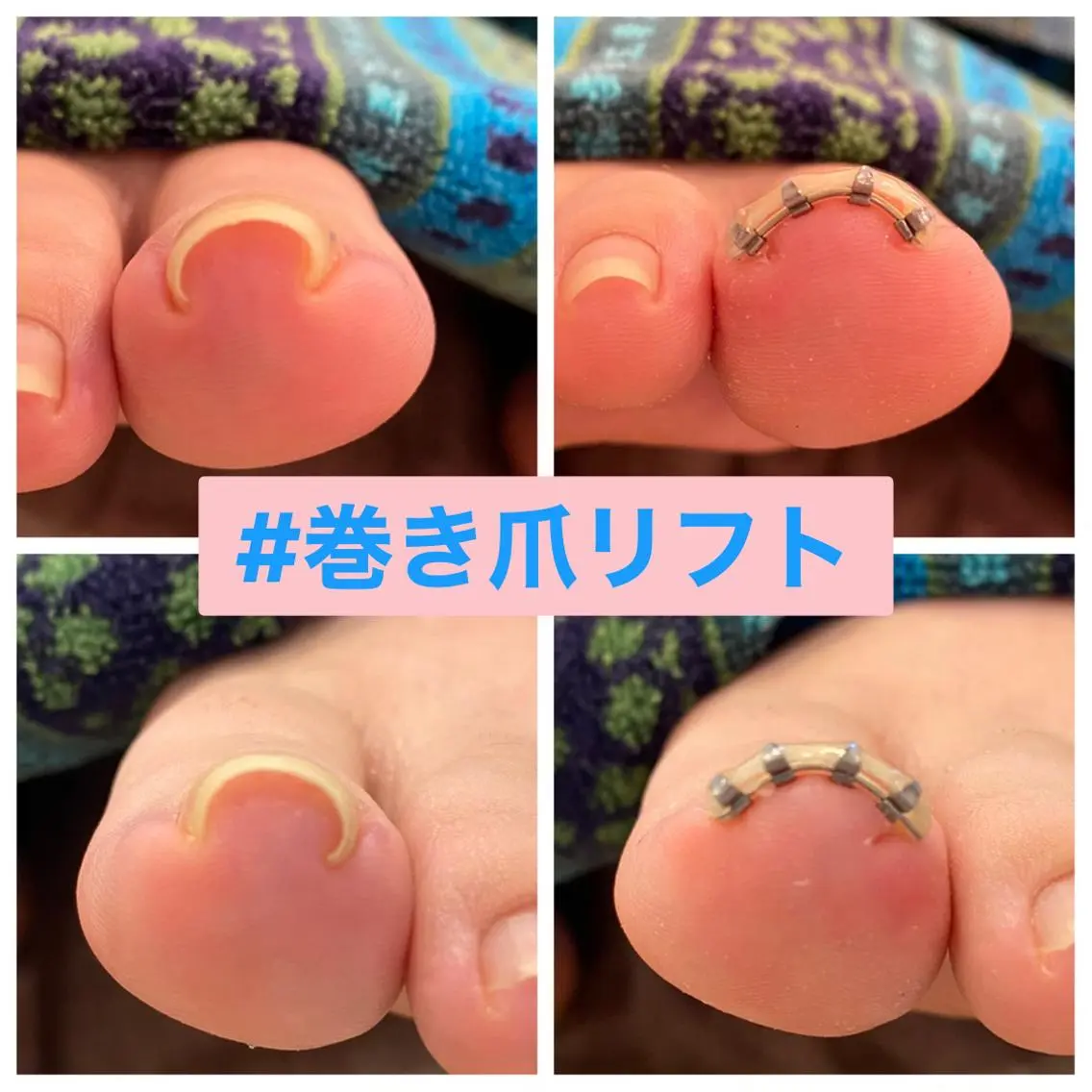 ネイル ♢ME2ROOM♢ #巻き爪#リラクのネイルデザイン
