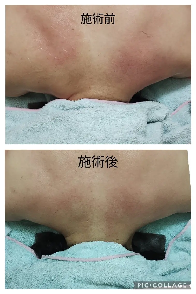 背面マッサージ✨️筋膜の癒着を解消★】首、肩、肩甲骨コリ・温感筋膜リリースの写真