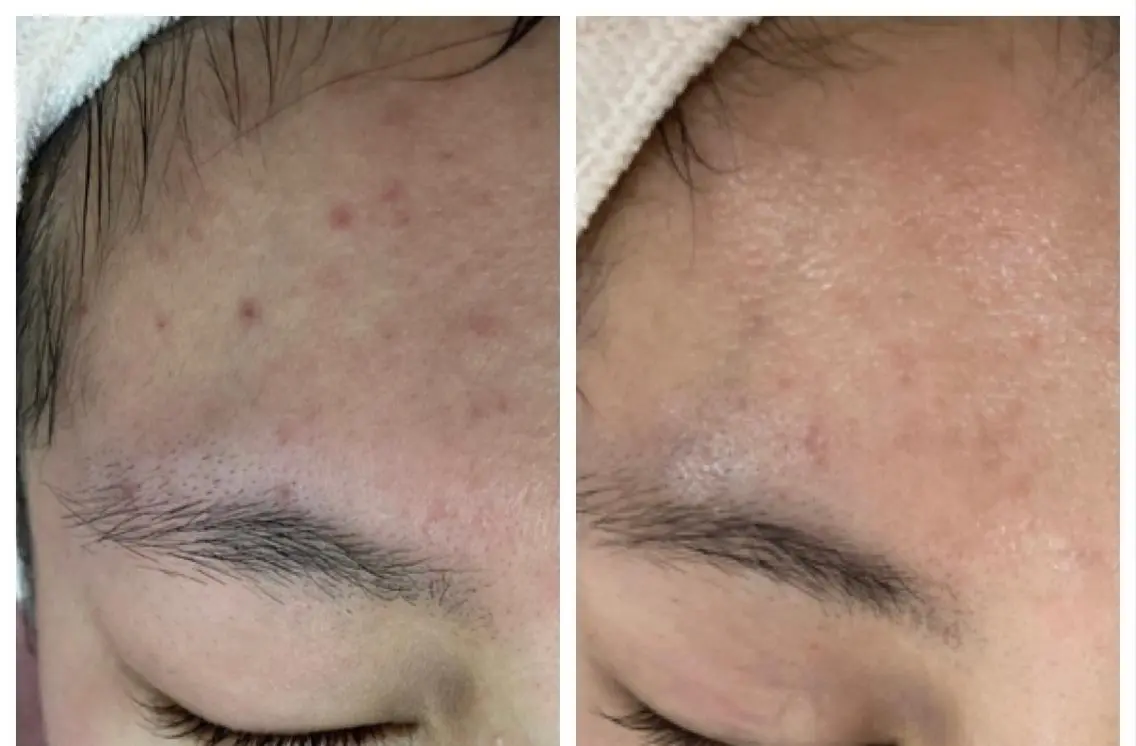 【ニキビ肌】お悩み別の肌質改善&メイクで至福の90分。初回のみ120分。通常¥7700→¥4500ミニモ特別価格です☺️の写真