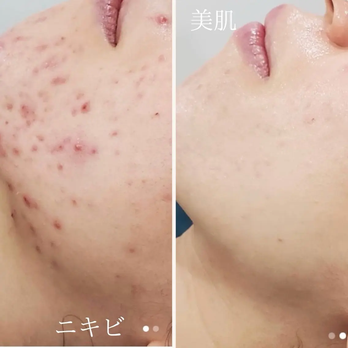 ＼繰り返す肌荒れ・ニキビケアに／AHAピーリング＋美白パック◎土台から整える根本ケア◎の写真