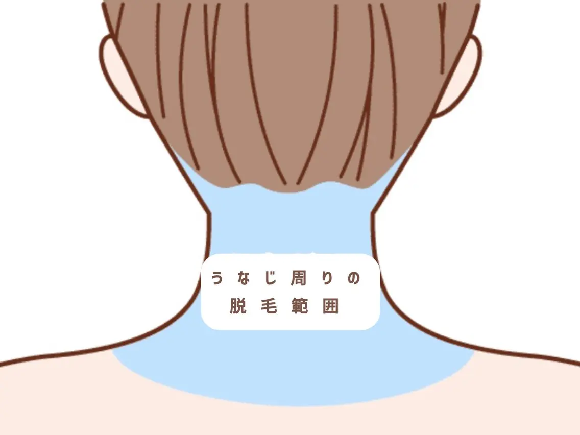✨話題のネープケア✨うなじラインまるごと脱毛✨【後ろ姿に差をつける】うなじ•首•背中セット割¥3300の写真