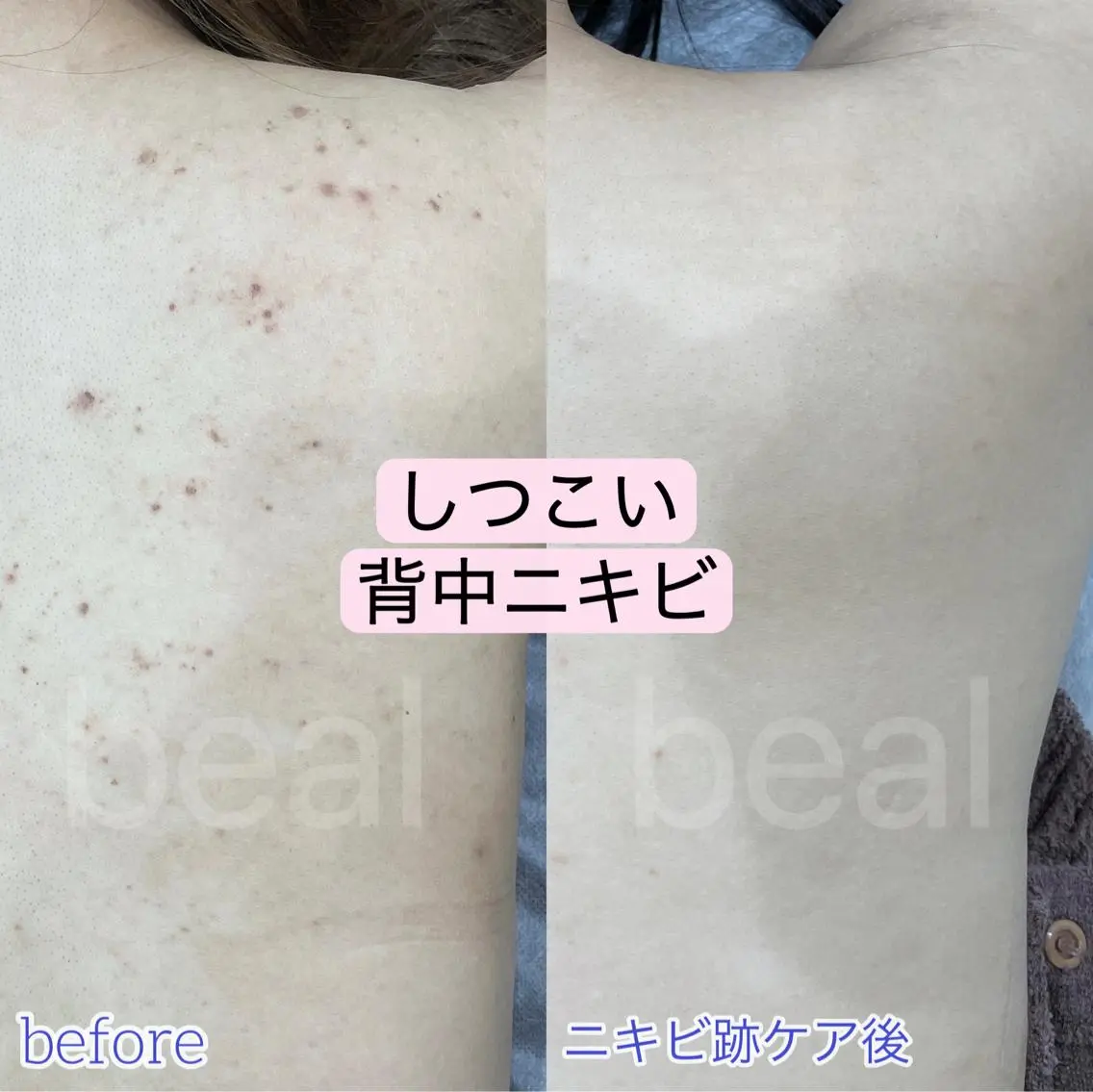 小顔/毛穴/ニキビ salon bealのエステ・リラクイメージ