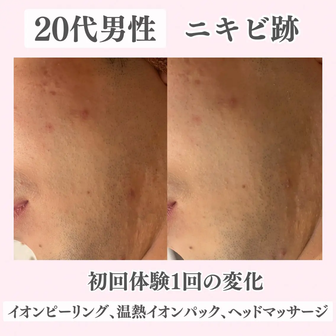 エステ リラク ニキビ・肌質改善専門 ♡人生が変わるサロンのエステ・リラクイメージ