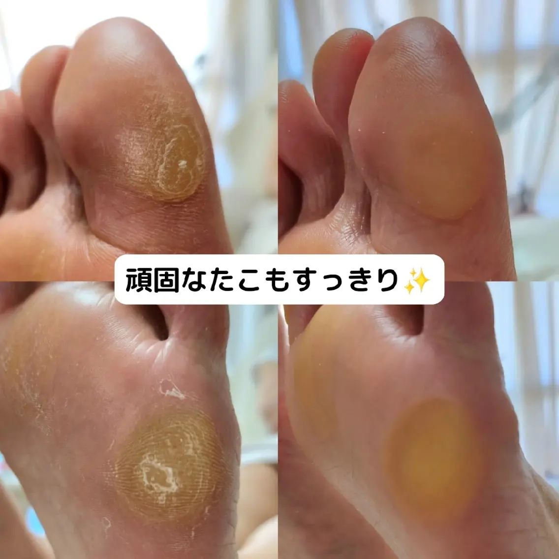 足裏角質ケアフルコース👣ケアコースにお爪切りと甘皮ケアがついたコースです🦶✨の写真