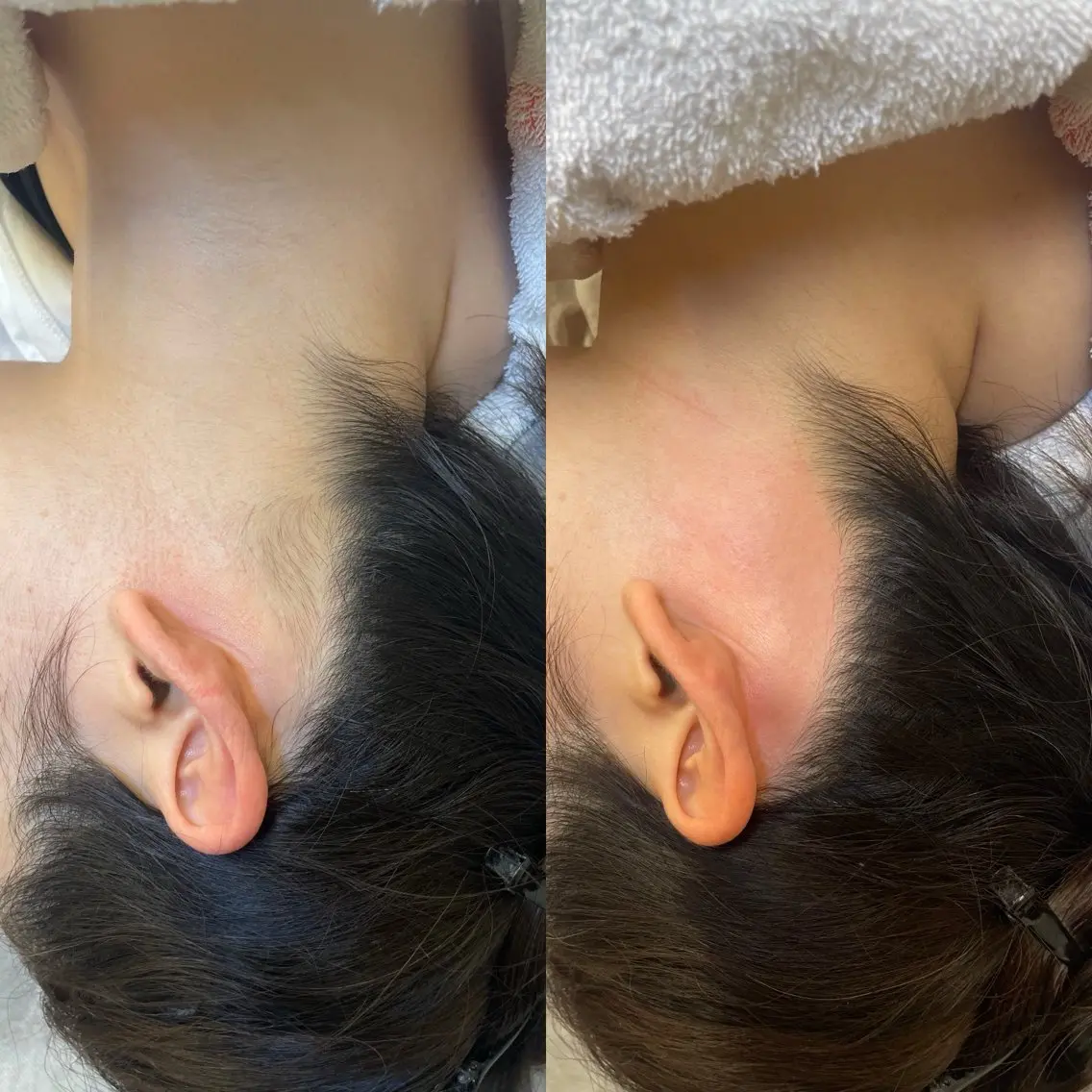 女性限定【うなじワックス脱毛👩🏻‍🦰】スキルアップレッスンモデルの写真
