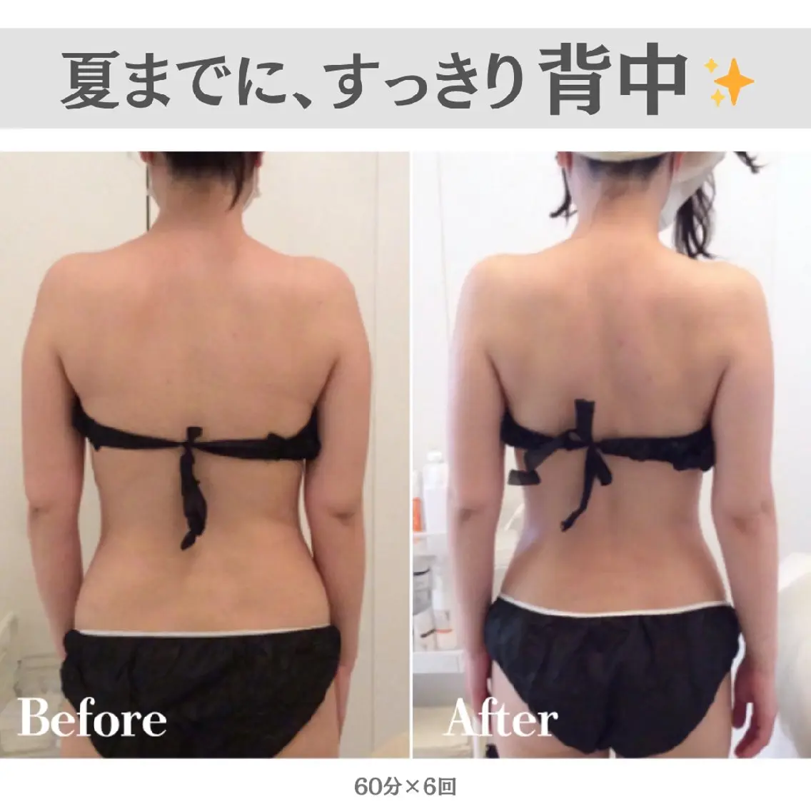 【背中・二の腕集中】夏までに、すっきり背中✨（残り2名様｜30分施術プレゼント🎁）短期集中痩身60分×6回の写真