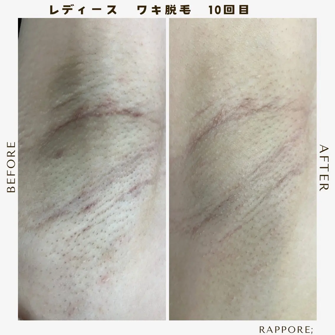 脱毛&フェイシャル/ Rappore;増田のエステ・リラクイメージ