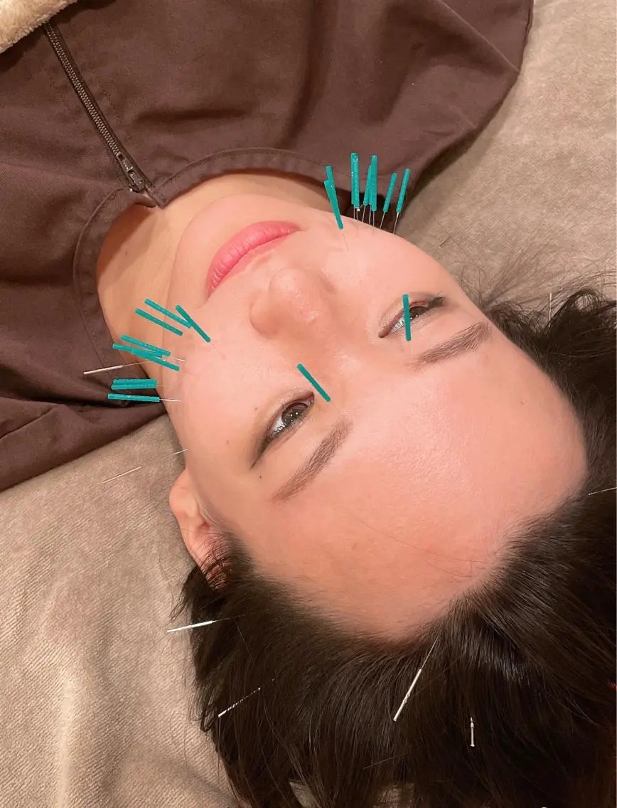🍀オーダーメイド美容鍼 🍀おすすめNO.1の写真