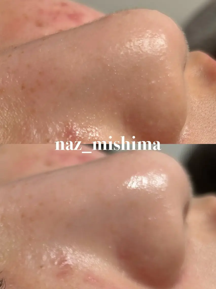 【📸写真モデル】毛穴洗浄の Before/After撮影にご協力いただける方を募集しています！の写真