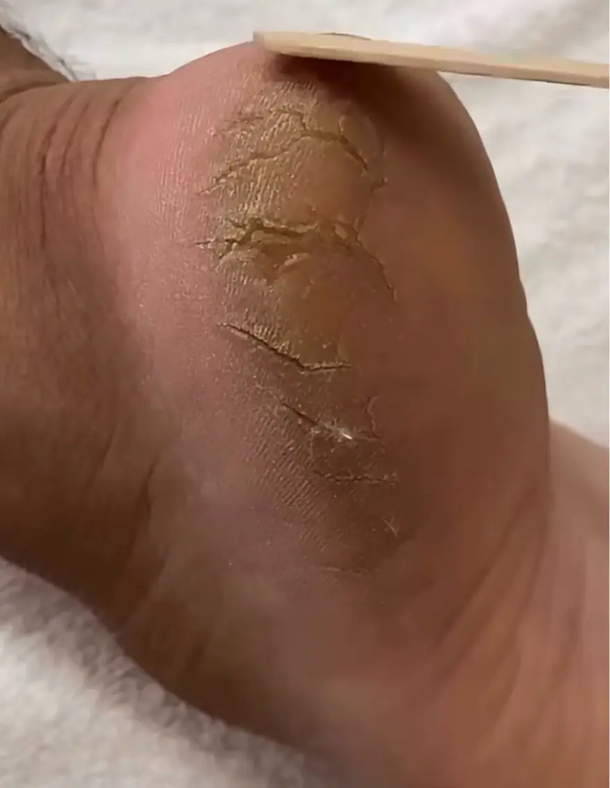 動画モデル募集先着5名⭐️フットケア&足裏の角質ケア【定員になりましたので条件厳しくしております】の写真