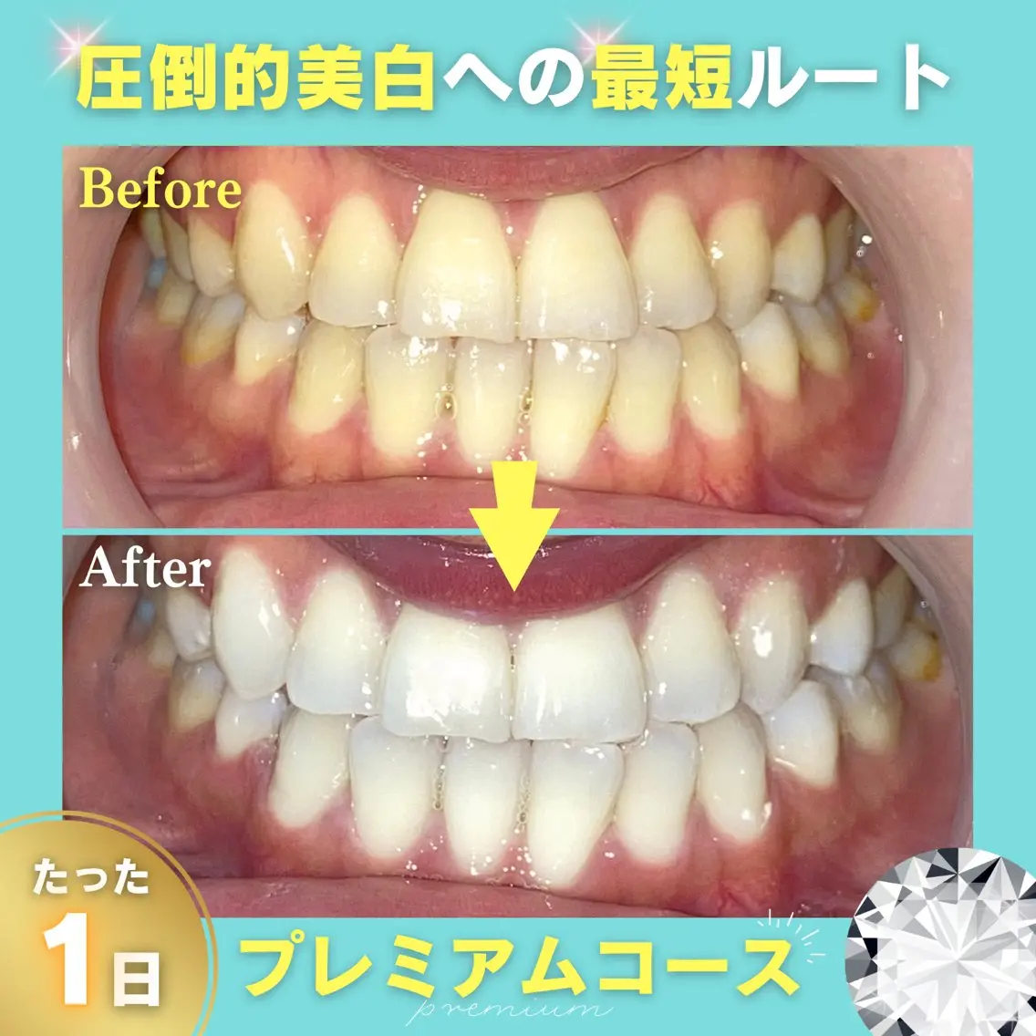 《人気No.1◎圧倒的美白》プレミアムホワイト 10分×3回 ¥14,940 → ¥6,000の写真