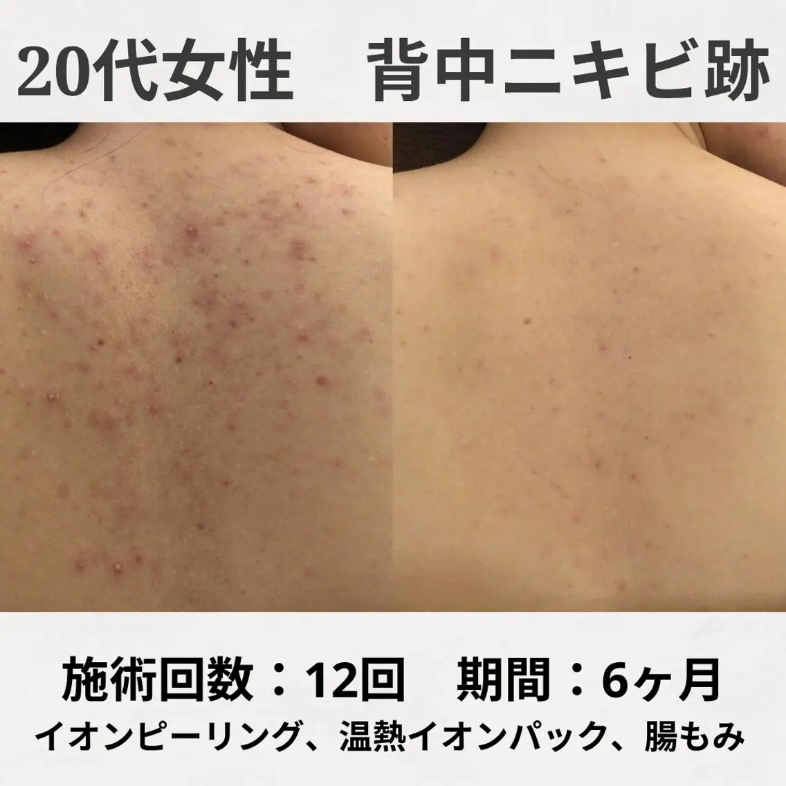 ニキビ跡改善専門🔥 医療にはできない改善のエステ・リラクイメージ