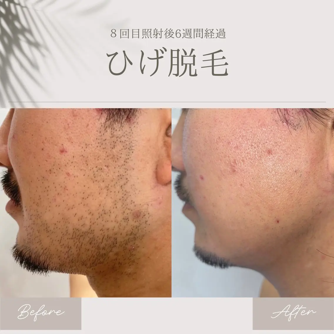 脱毛 脱毛サロン ATENAのエステ・リラクイメージ