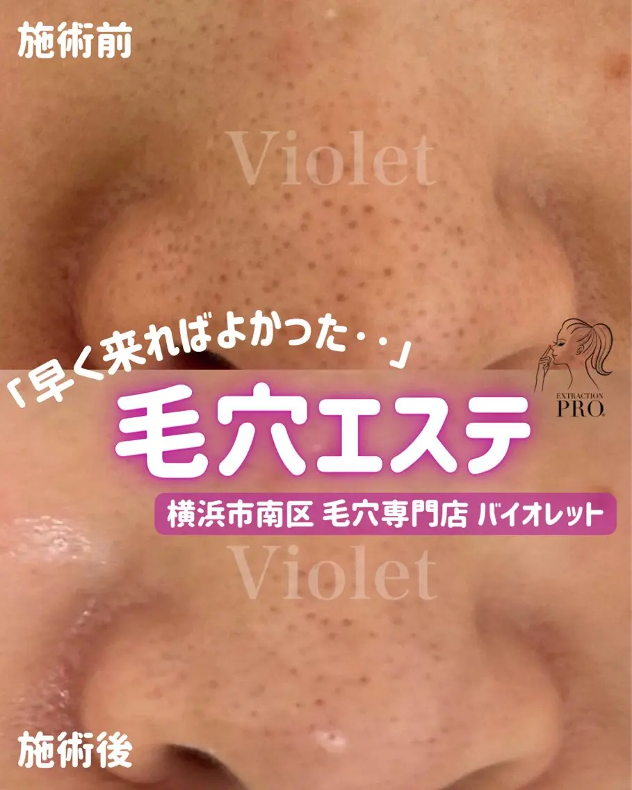 その他 毛穴と耳つぼ専門店 バイオレット　りののその他イメージ