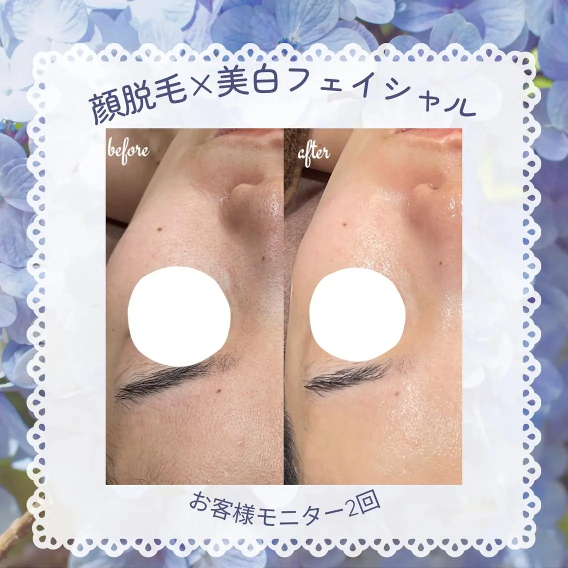 脱毛 🌷毛穴エステ レイビスMURA🌷のエステ・リラクイメージ
