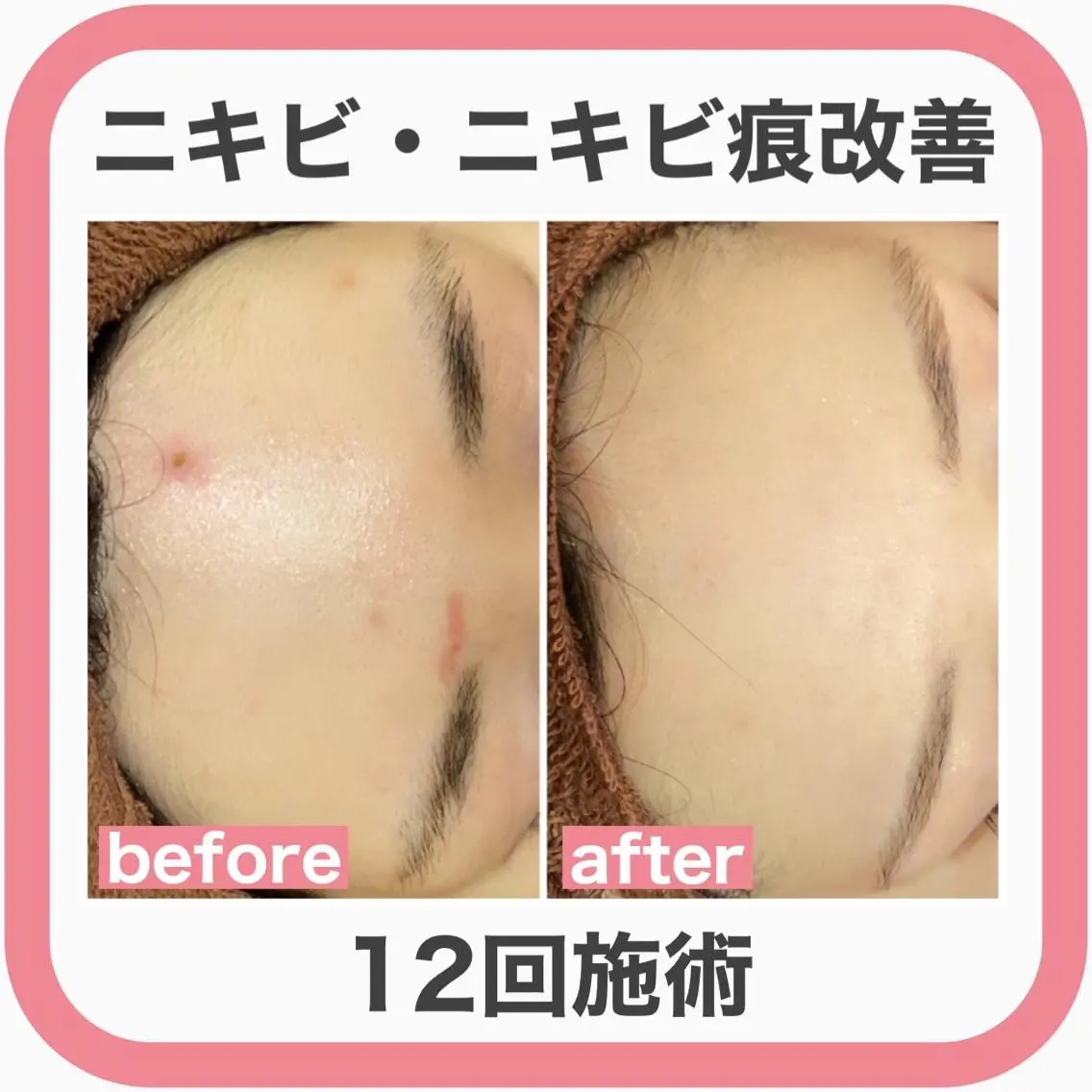 セミロング カラー パーマ ヘアアレンジ メンズ キッズ ネイル マツエク・マツパ アイブロウ 3か月で肌革命👼 ニキビ専門店💫のエステ・リラクイメージ