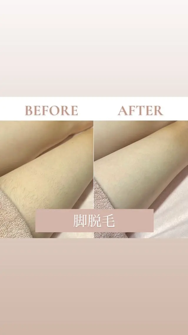 【ぽつぽつ毛穴•チクチク感でお悩みの方へ】🌟脚丸まるごと(指先まで)🌟の写真