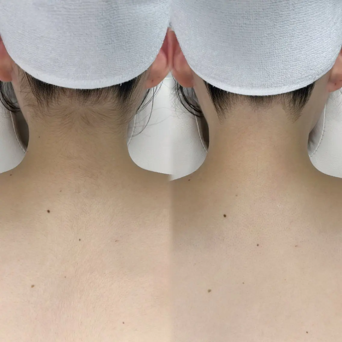 【 脇+うなじ+背中上脱毛🫧 】成人式/前撮り/ウエディング/卒業式/入学式の写真