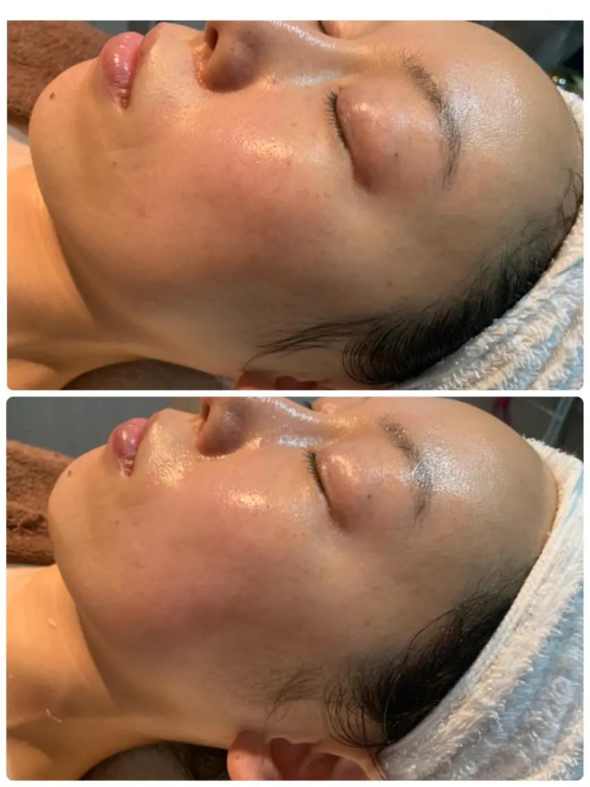 お顔のむくみ？お顔が大きくなったような😱という方。顔が四角になってきたような😱という方是非受けてみてください。の写真