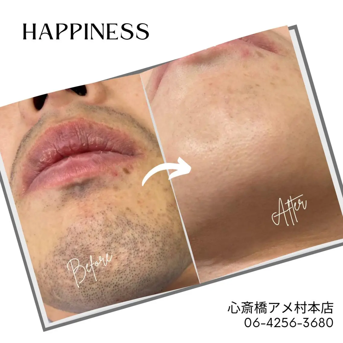 【初回限定】㊚㊛可能‼️[ 顔] 脱毛✨１回2,000円(施術時間15分)の写真