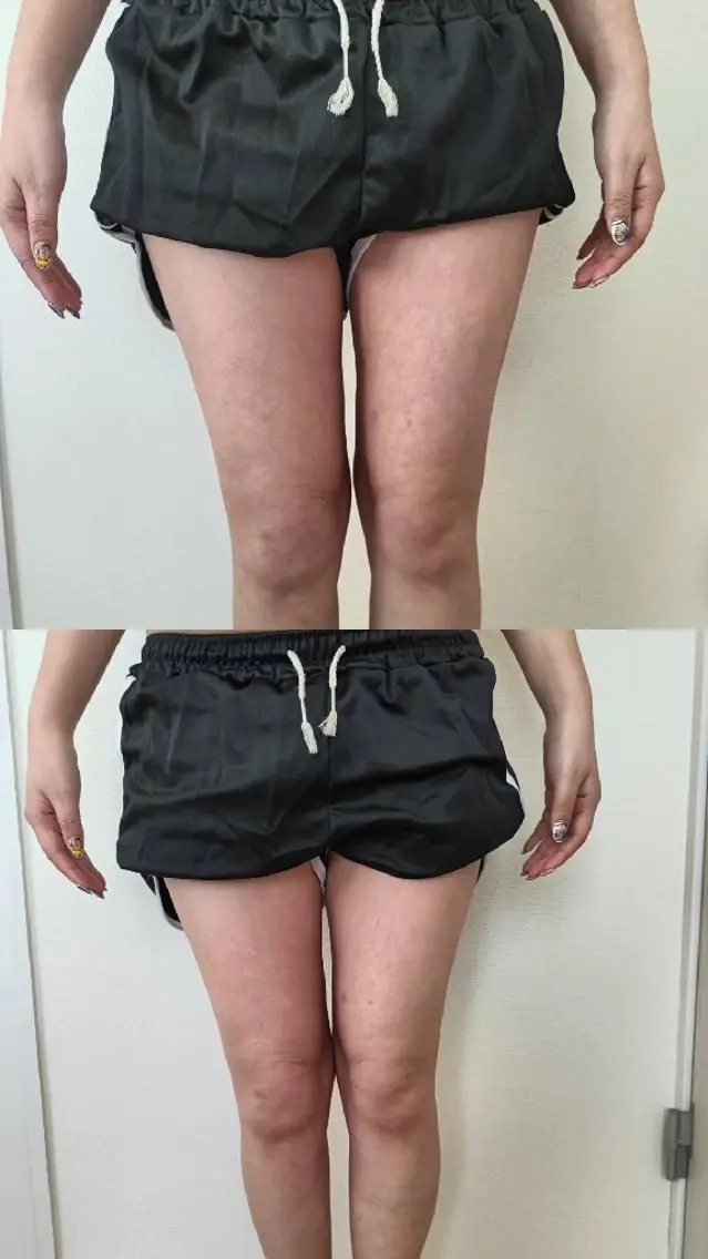 「着たい服」を諦めない。大人のための部分彫刻キャビテーション 90分の写真