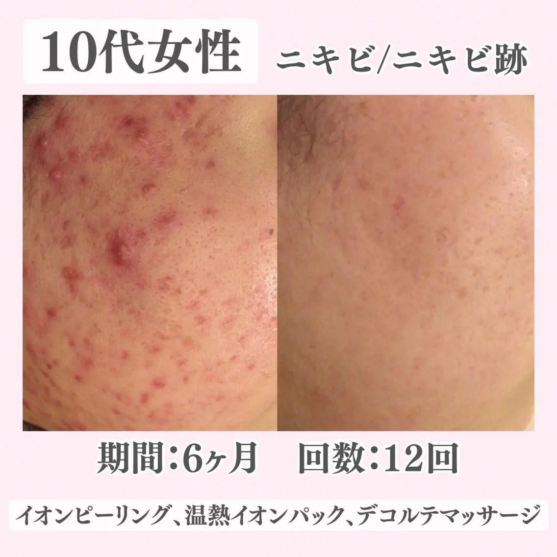 エステ リラク ニキビ・肌質改善専門 ♡人生が変わるサロンのエステ・リラクイメージ