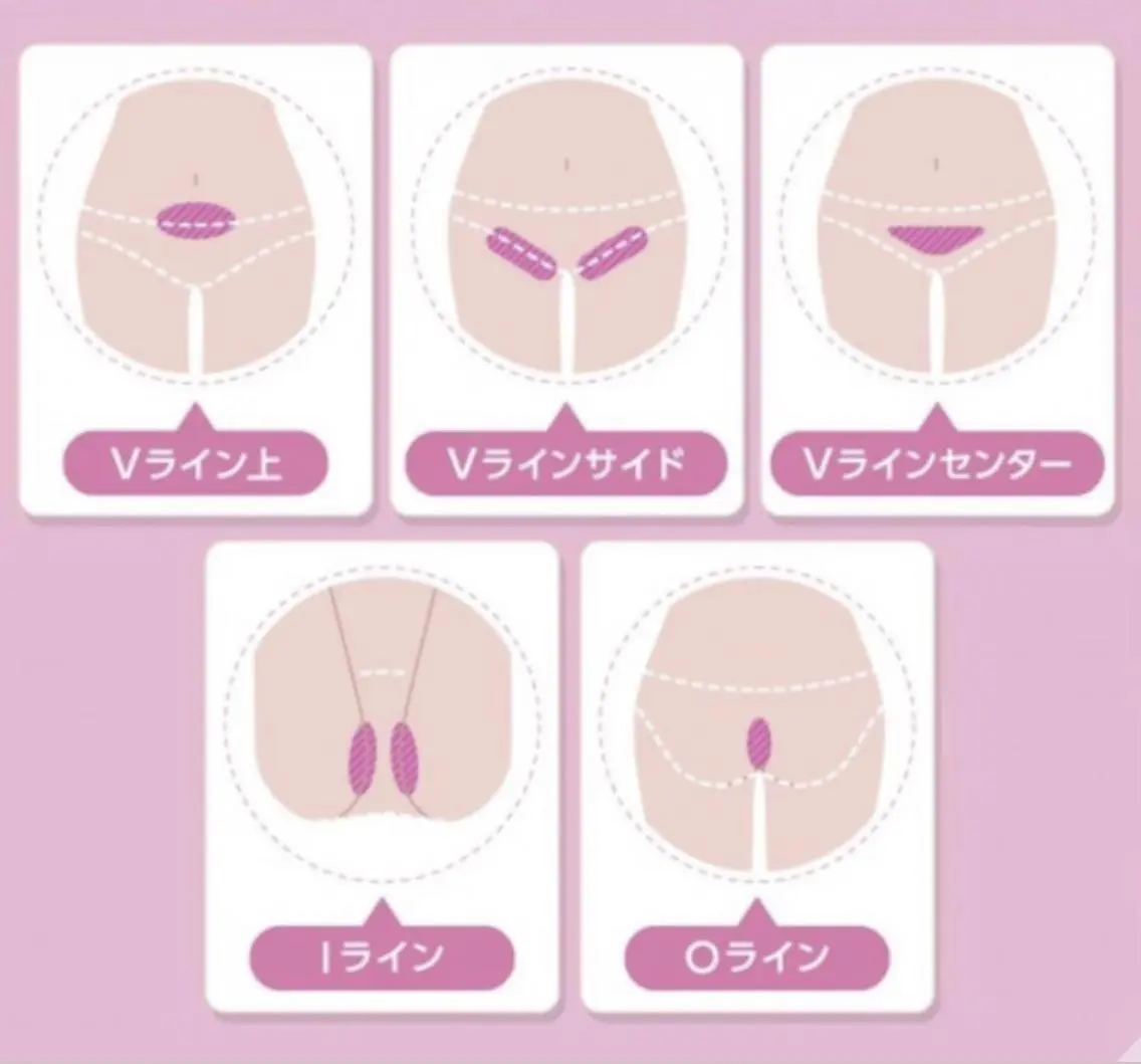 6月限定🌟熱破壊式VIO美肌脱毛🌟完全シェービング付で冷却機能・全当て可能・透明感のある肌💞創業40年実績の写真