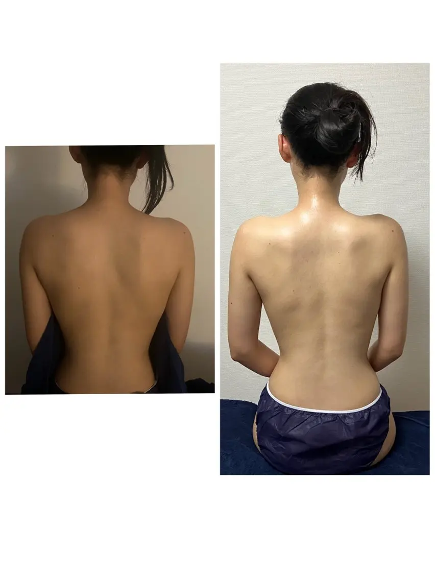 【ブライダル】二の腕&肩甲骨はがし+フェイシャル+デコルテ、ネック、ドライヘッド60分の写真