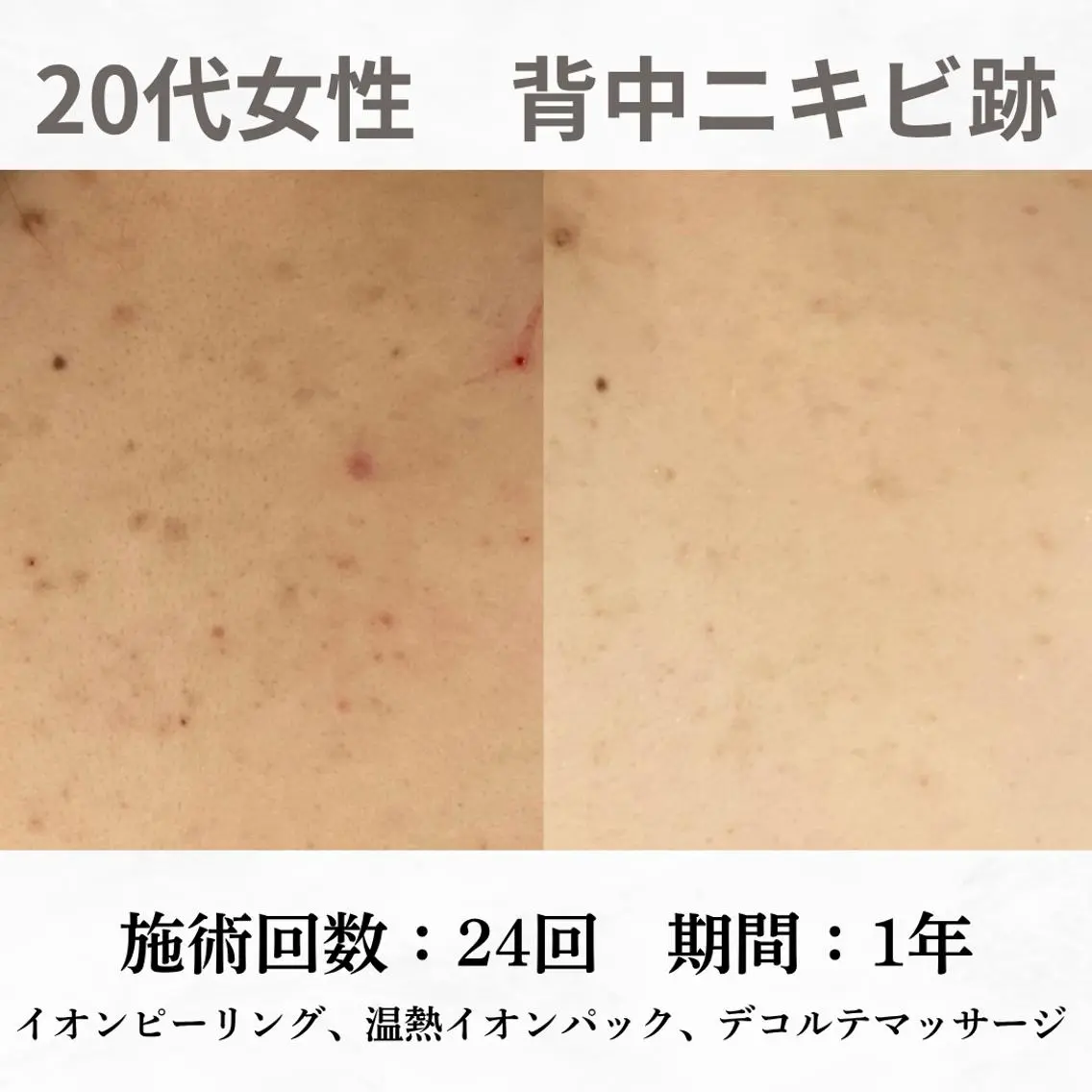 重度ニキビ専門🌼 ダウンタイムなしのエステ・リラクイメージ