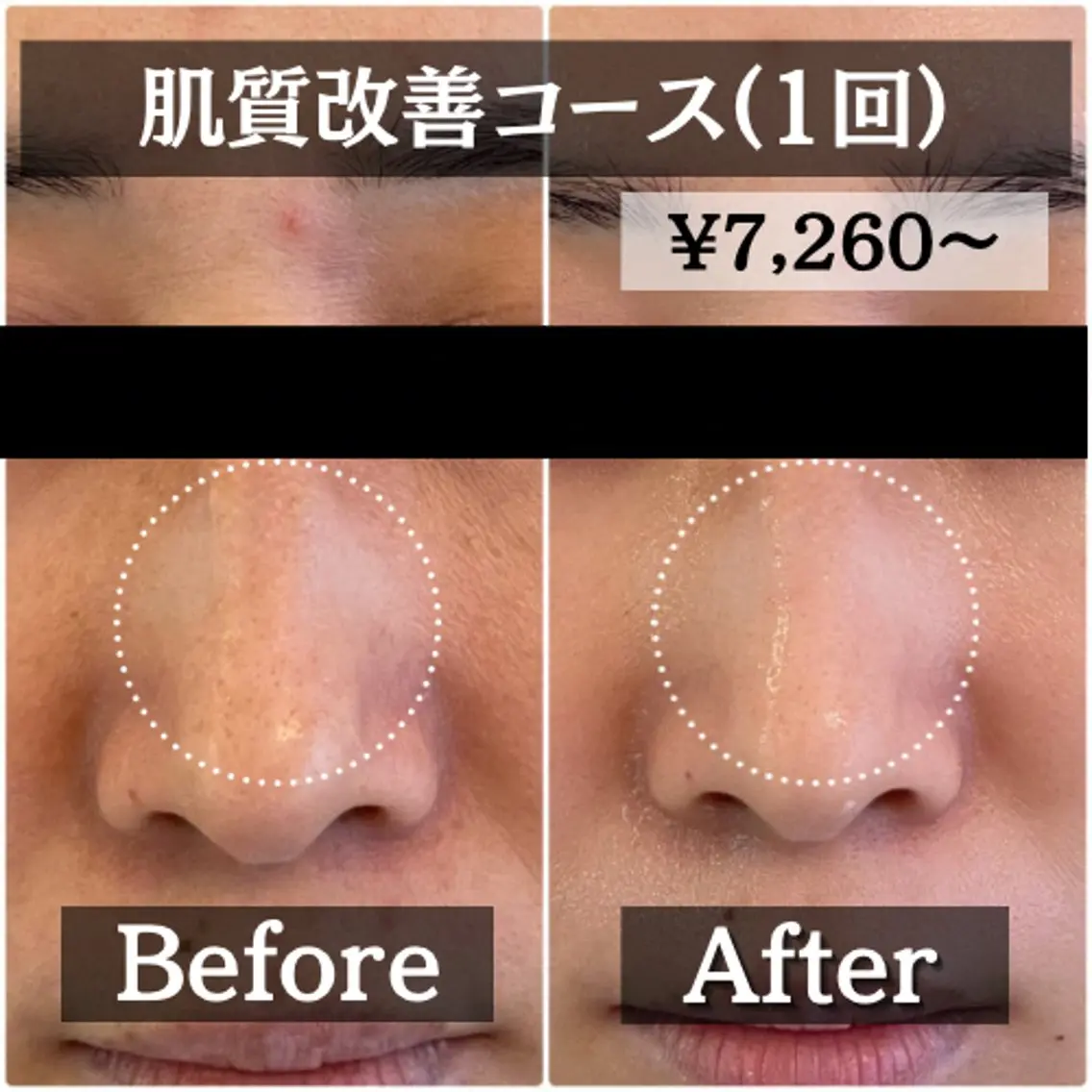 【ミニモ限定】開き/黒ずみ/たるみ毛穴 毛穴レスでツルスベ肌に♪肌質改善マッサージピール¥9,900→¥7,280の写真