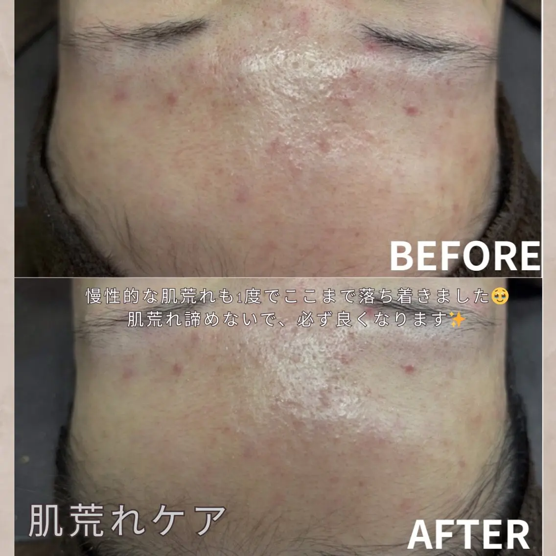 【ニキビ肌から艶肌に✨】お試しダウンタイム痛みなし✖️ニキビ跡や軽度のクレーターにも◎幹細胞ハーブピーリング🌿90分の写真
