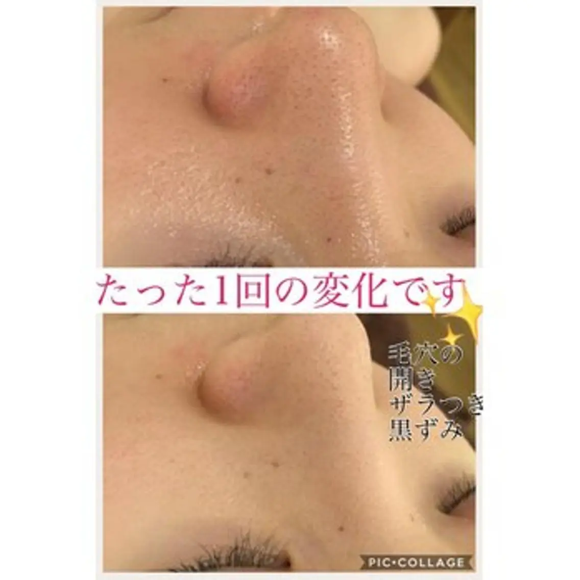 エステ リラク 3か月で肌革命👼 ニキビ専門店💫のエステ・リラクイメージ