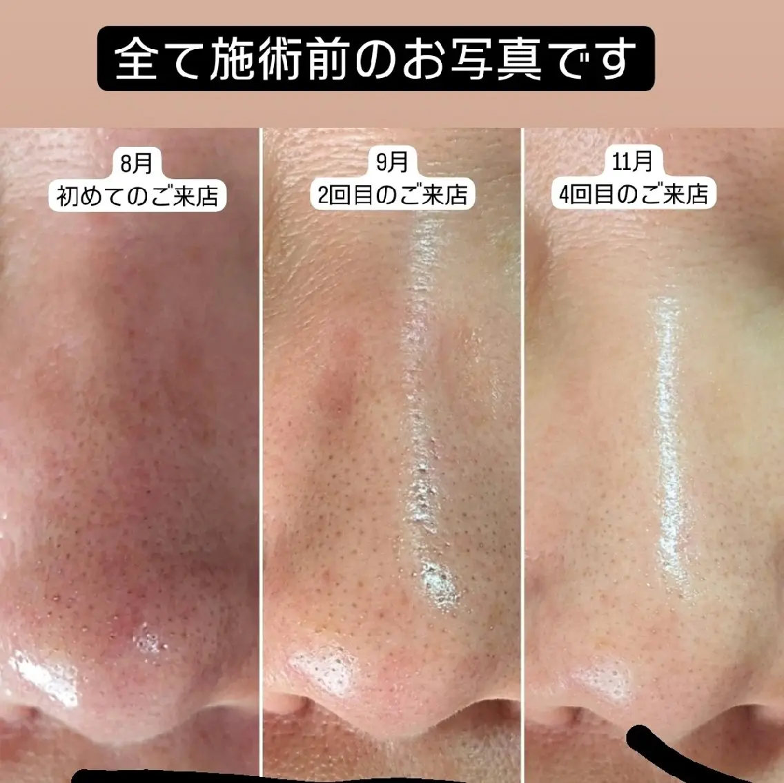 6月平日限定価格の毛穴洗浄‼️の写真