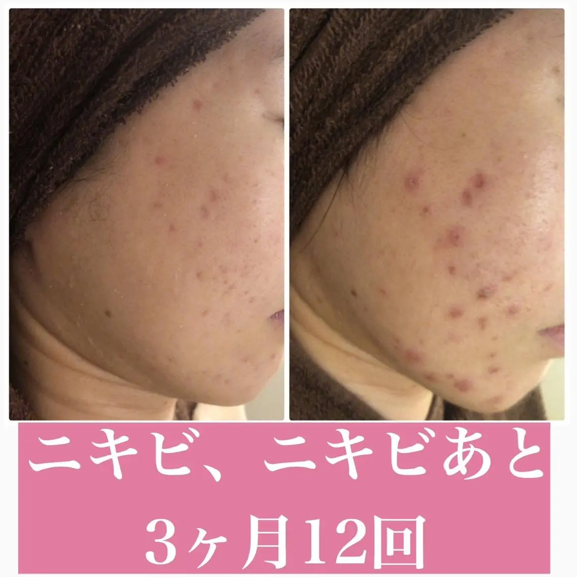 セミロング カラー パーマ ヘアアレンジ メンズ キッズ ネイル マツエク・マツパ アイブロウ 3か月で肌革命👼 ニキビ専門店💫のエステ・リラクイメージ