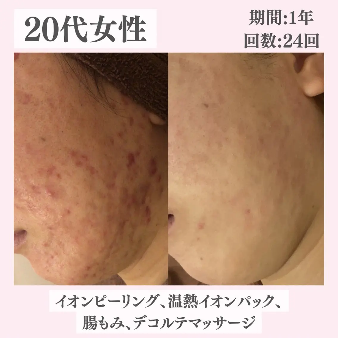 エステ リラク ニキビ・肌質改善専門 ♡人生が変わるサロンのエステ・リラクイメージ