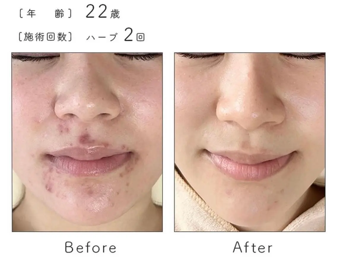 エステ ハーブピーリング専門 BIOPLUS+川崎のエステ・リラクイメージ