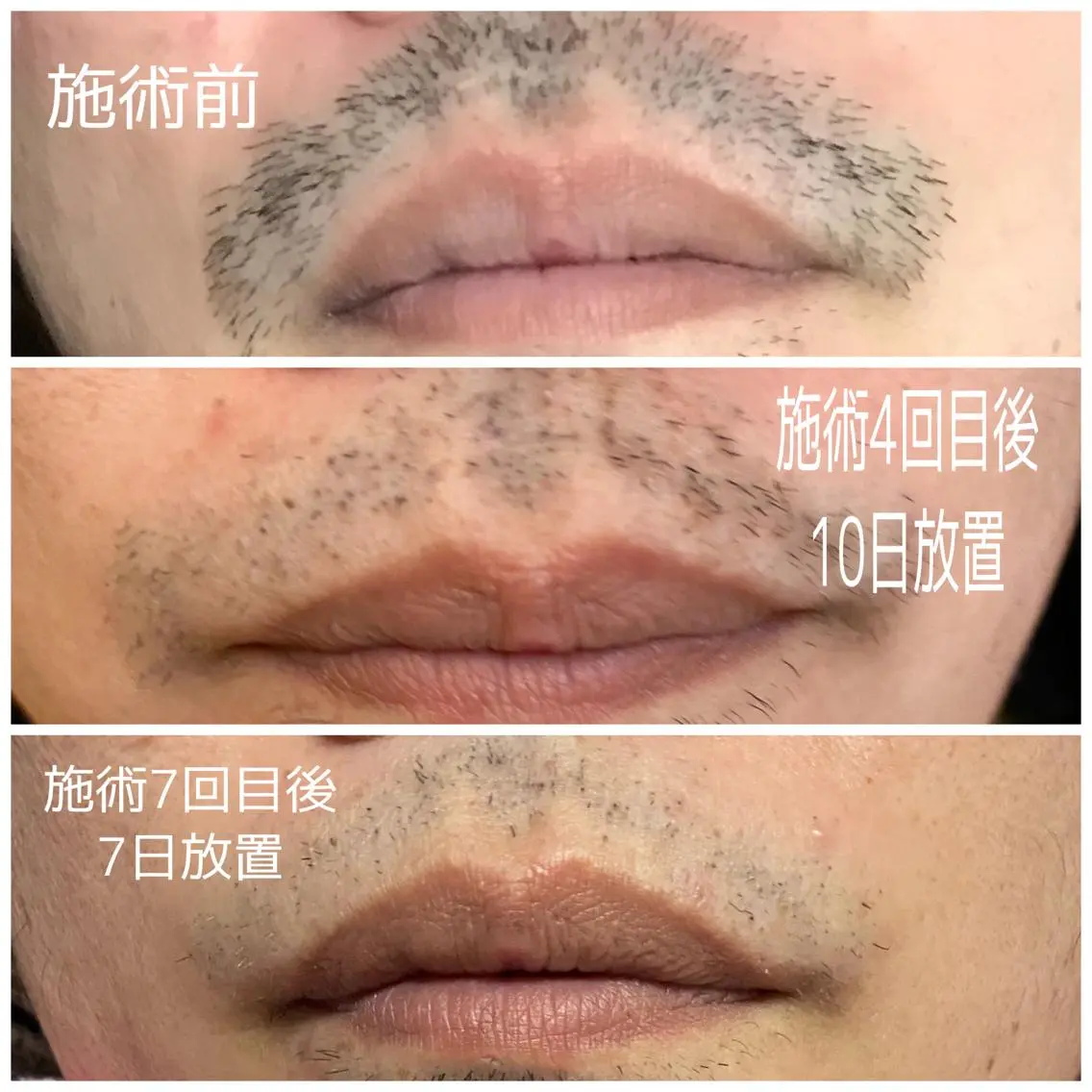 痛くない!最新SHR脱毛!男性髭脱毛(口周り、あご、ほほ)の写真