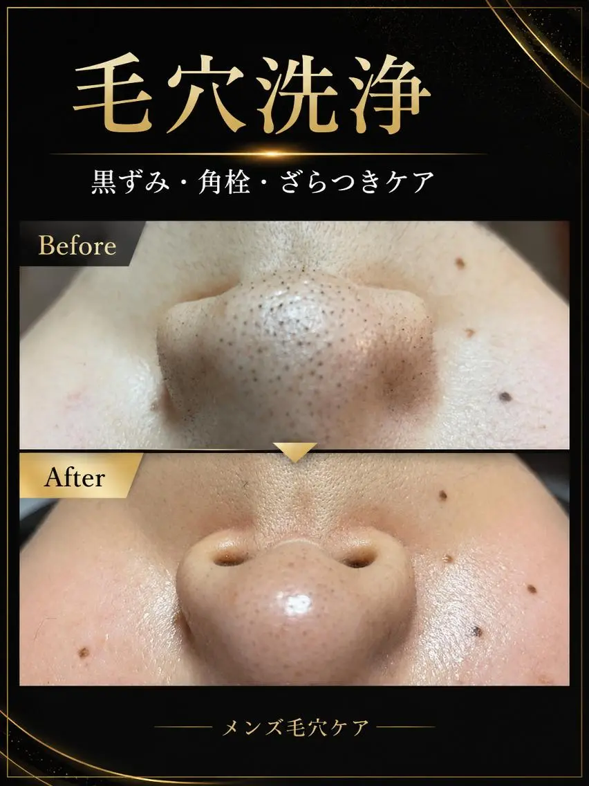 【毛穴洗浄】メンズ毛穴洗浄体験 ¥980|黒ずみ・角栓の写真