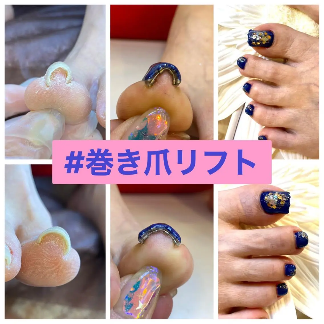 ネイル ジェルネイル ♢ME2ROOM♢ #巻き爪#リラクのネイルデザイン