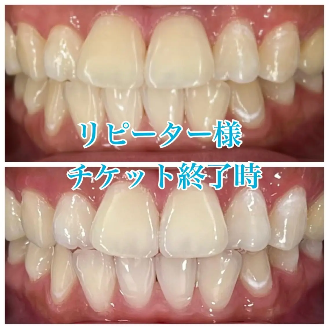 １カ月通い放題✋ホワイトニング1回20分💛早く白くなりたい方はぜひ😋の写真