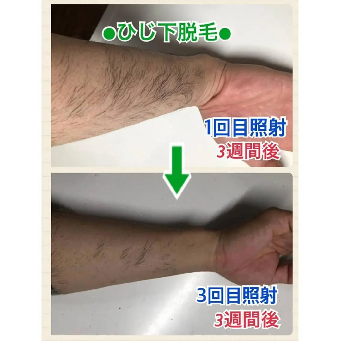 メンズ キッズ 脱毛 BiSTA ヒロのエステ・リラクイメージ