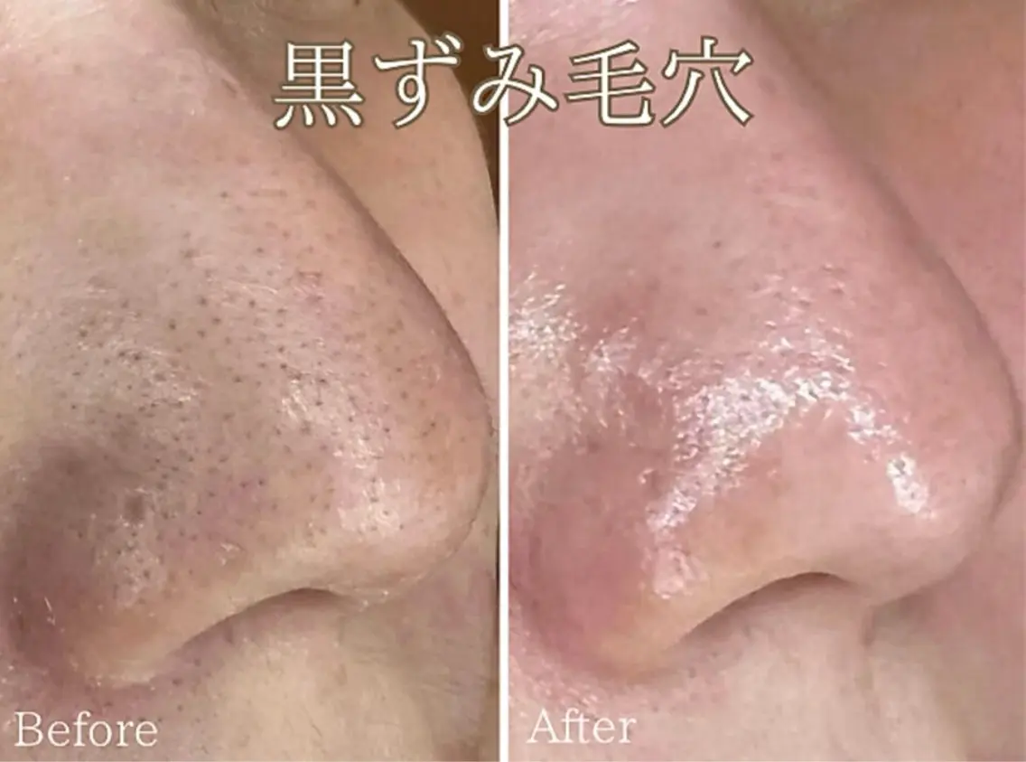 水素水毛穴洗浄 モデル様募集✨の写真