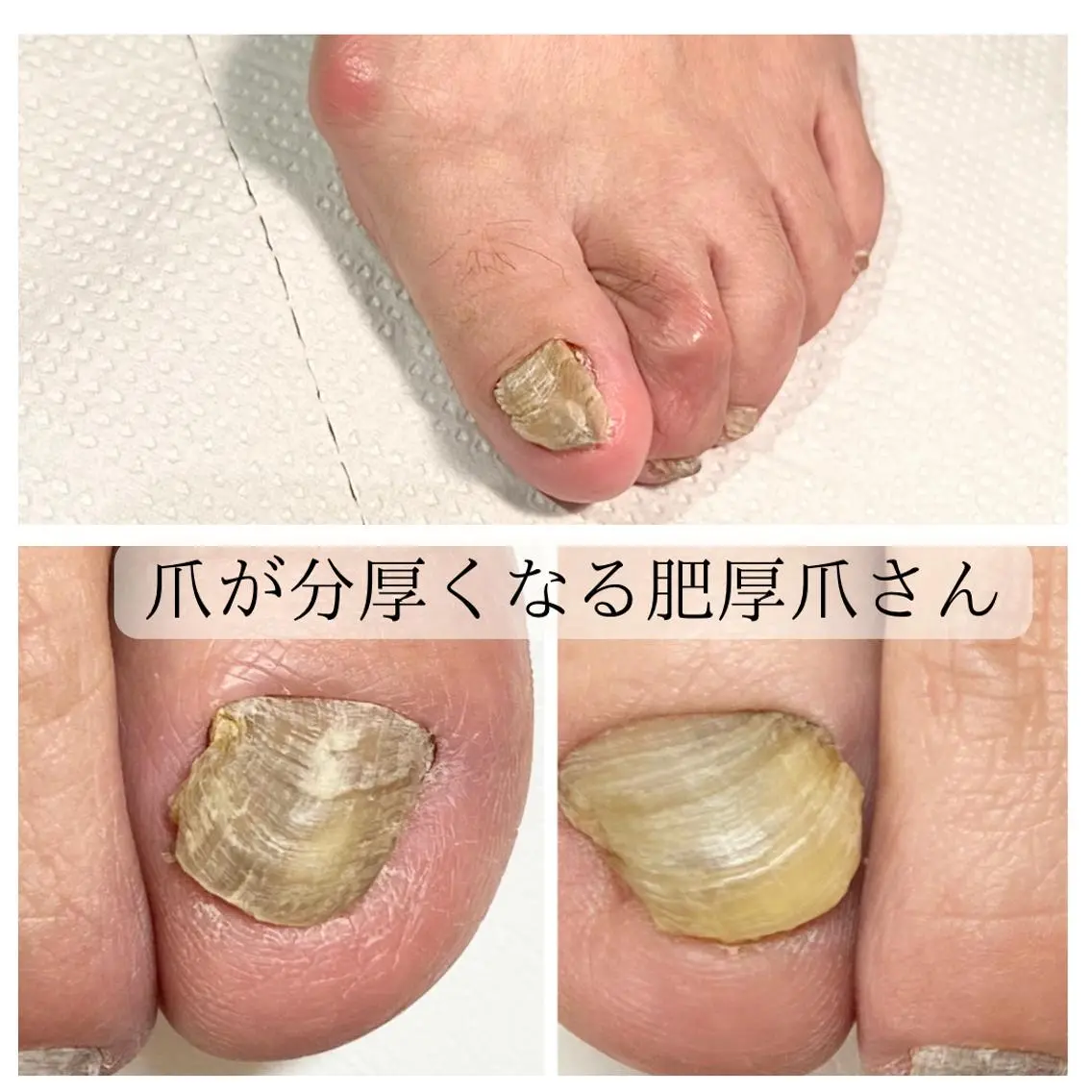 ネイル 巻き爪・肥厚爪ケア 専門サンセリテのネイルデザイン