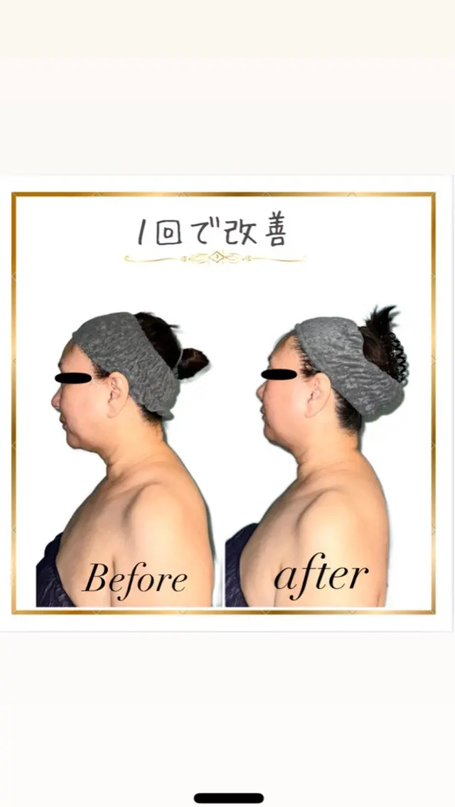 【辛い慢性的な首肩こり】全身の筋膜リリース＆リンパドレナージュの写真