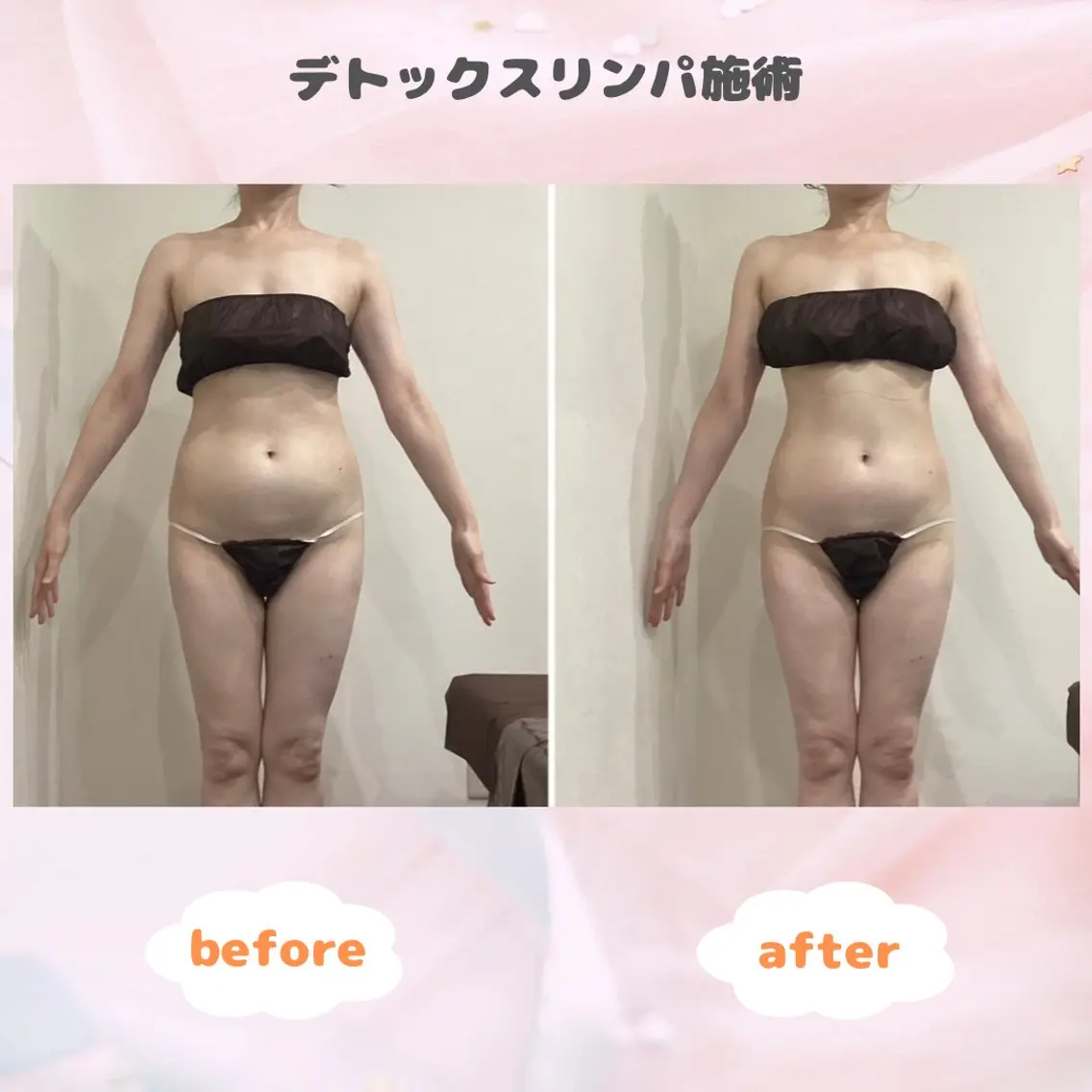 【部位別ダイエットに◎】選べる上or下半身×2回✨デトックスリンパ&最新ラジオ波🔥老廃物ドバドバ温活ダイエット🔥の写真