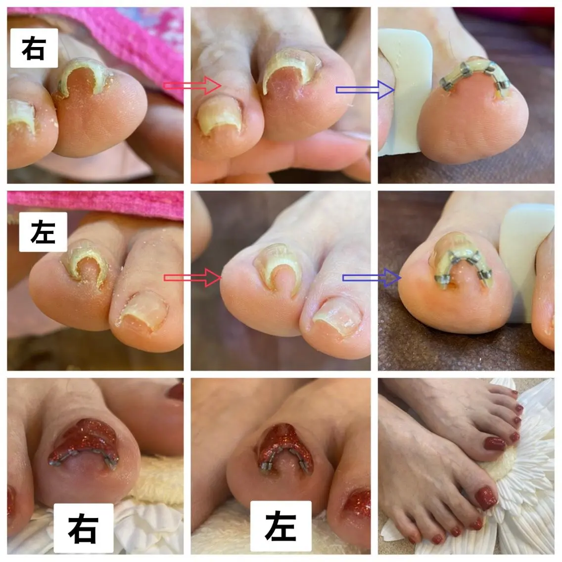 ネイル ♢ME2ROOM♢ #巻き爪#リラクのネイルデザイン