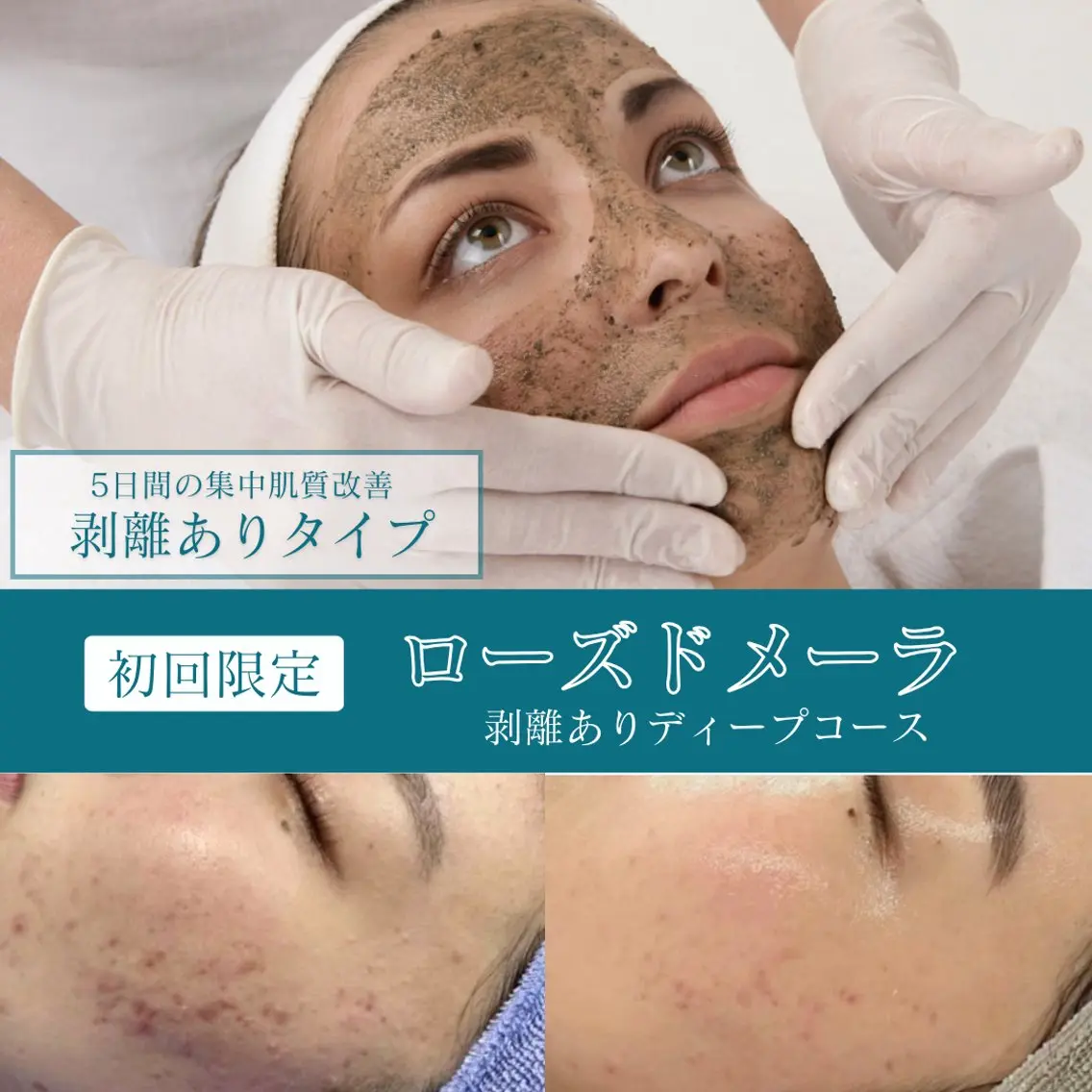 【6/12まで限定❗️】剥離ありハーブピーリング🌿5日間の本格肌質改善✨ニキビ/ニキビ跡/クレーター/シミ◎の写真